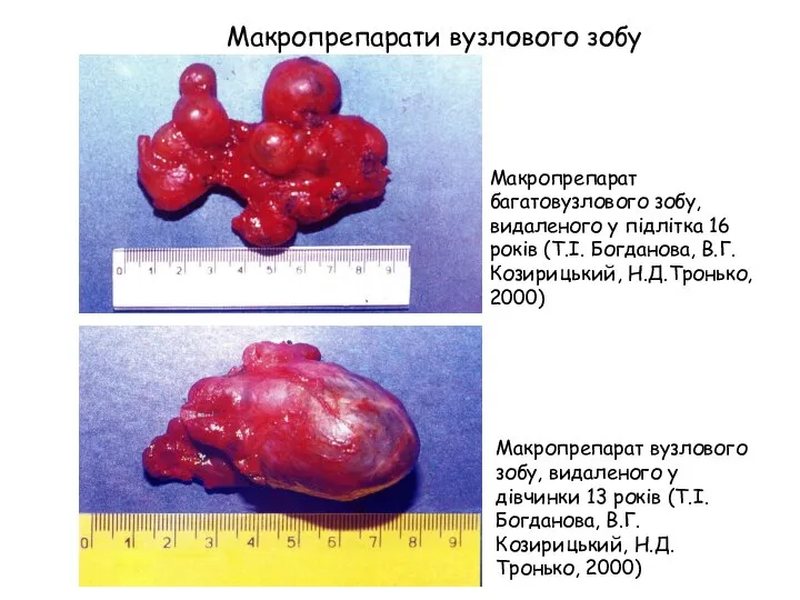 Макропрепарат багатовузлового зобу, видаленого у підлітка 16 років (Т.І. Богданова, В.Г.