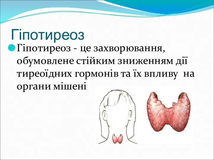 Гіпотиреоз Гіпотиреоз - це захворювання, обумовлене стійким зниженням дії тиреоїдних гормонів