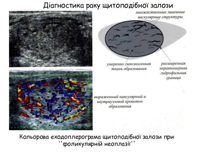 Кольорова еходоплерограма щитоподібної залози при ''фоликулярній неоплазії'' Діагностика раку щитоподібної залози