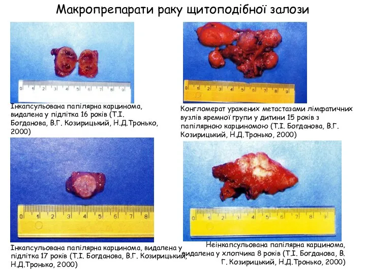 Інкапсульована папілярна карцинома, видалена у підлітка 16 років (Т.І. Богданова, В.Г.