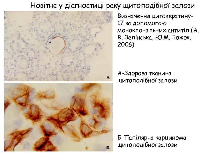 Визначення цитокератину- 17 за допомогою моноклональних антитіл (А.В. Зелінська, Ю.М. Божок,