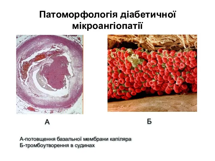 А Б А-потовщення базальної мембрани капіляра Б-тромбоутворення в судинах Патоморфологія діабетичної мікроангіопатії