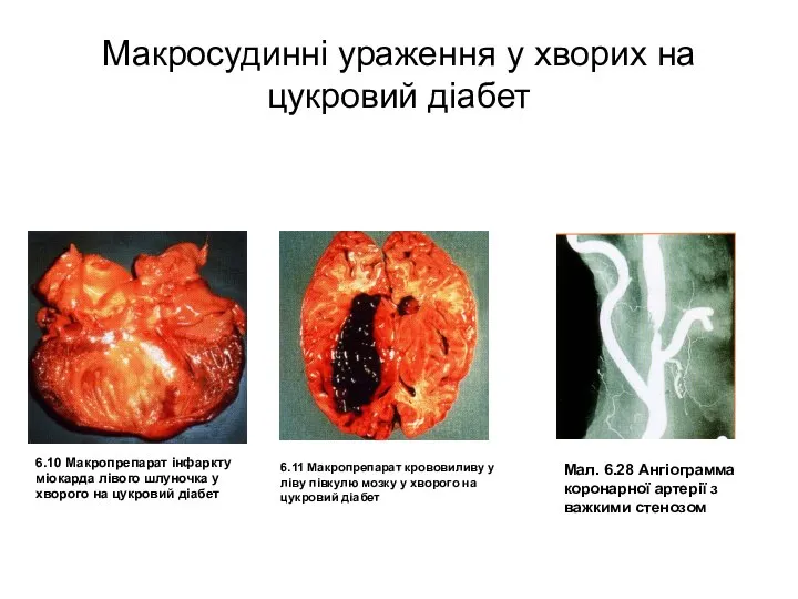 Макросудинні ураження у хворих на цукровий діабет 6.10 Макропрепарат інфаркту міокарда