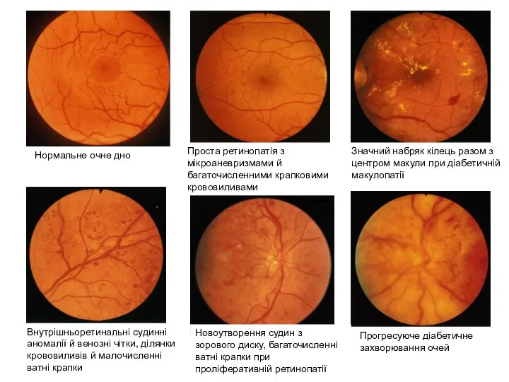 Нормальне очне дно Проста ретинопатія з мікроаневризмами й багаточисленними крапковими крововиливами