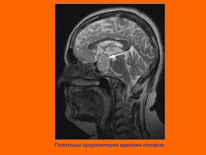 Гігантська супраселярна аденома гіпофіза