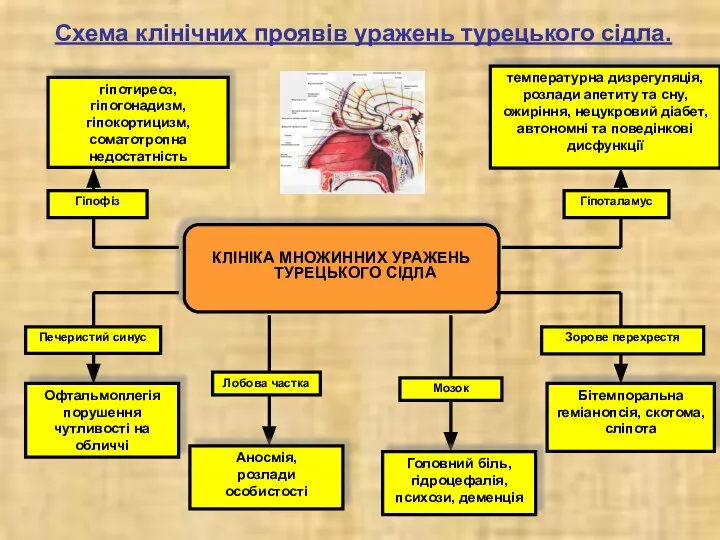 КЛІНІКА МНОЖИННИХ УРАЖЕНЬ ТУРЕЦЬКОГО СІДЛА гіпотиреоз, гіпогонадизм, гіпокортицизм, соматотропна недостатність температурна