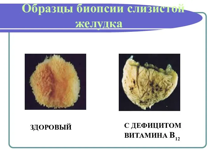 Образцы биопсии слизистой желудка ЗДОРОВЫЙ С ДЕФИЦИТОМ ВИТАМИНА В12