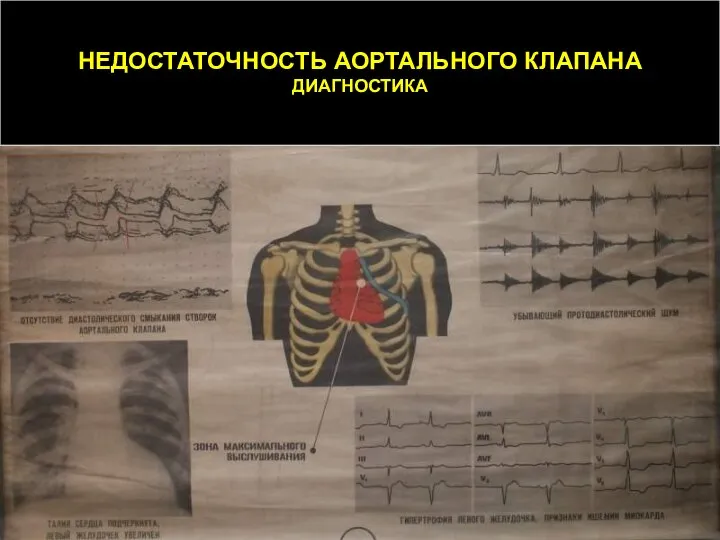 НЕДОСТАТОЧНОСТЬ АОРТАЛЬНОГО КЛАПАНА ДИАГНОСТИКА