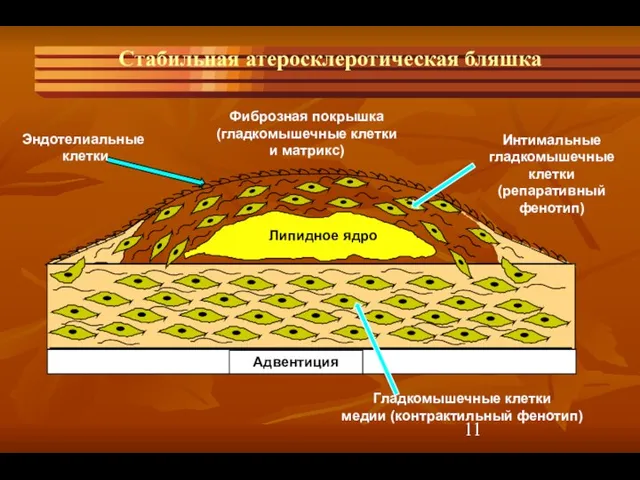 Стабильная атеросклеротическая бляшка Липидное ядро Адвентиция Фиброзная покрышка (гладкомышечные клетки и