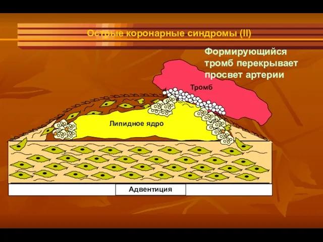 Адвентиция lipid core Липидное ядро Тромб Острые коронарные синдромы (II) Формирующийся тромб перекрывает просвет артерии