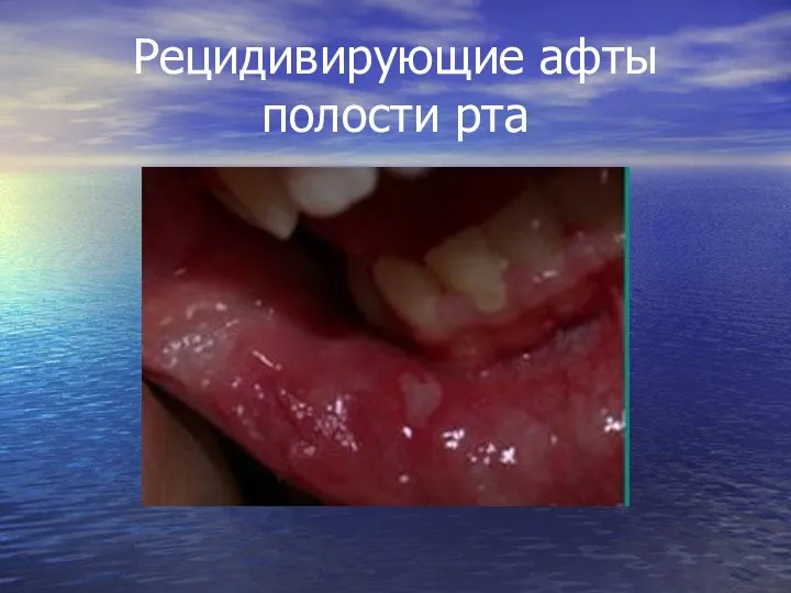 Рецидивирующие афты полости рта