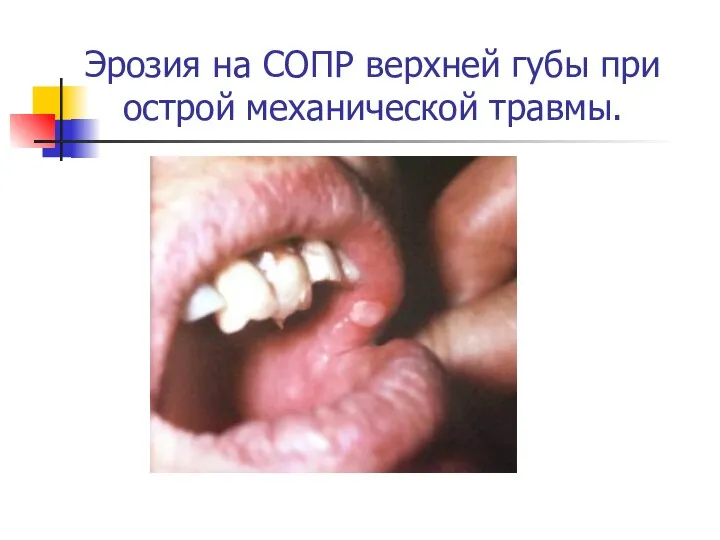 Эрозия на СОПР верхней губы при острой механической травмы.