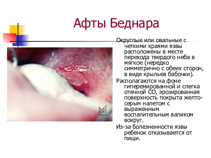 Афты Беднара Округлые или овальные с четкими краями язвы расположены в