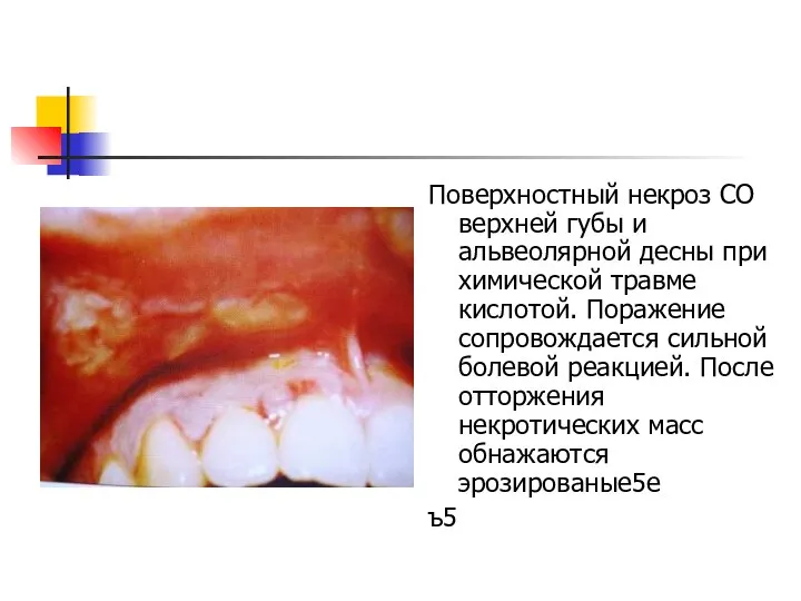 Поверхностный некроз СО верхней губы и альвеолярной десны при химической травме