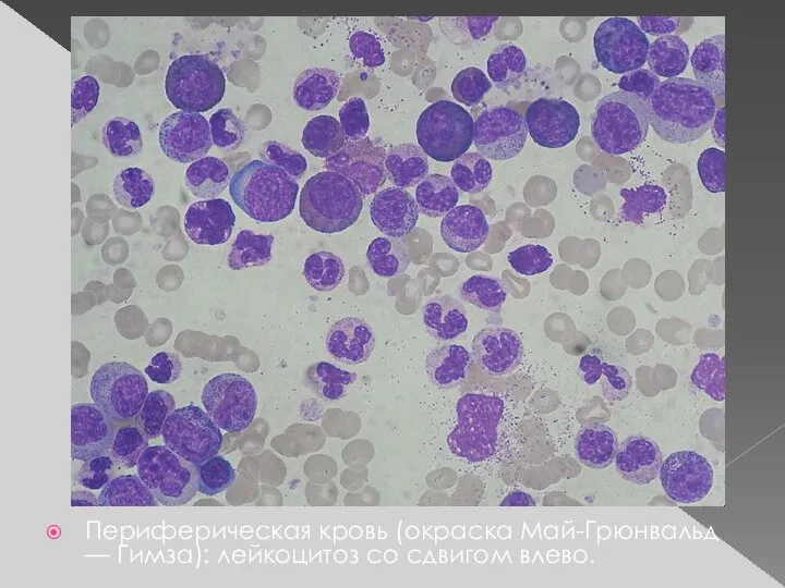 Периферическая кровь (окраска Май-Грюнвальд — Гимза): лейкоцитоз со сдвигом влево.