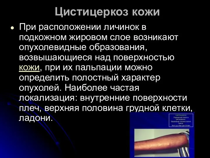 Цистицеркоз кожи При расположении личинок в подкожном жировом слое возникают опухолевидные