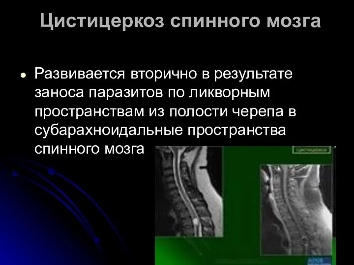 Развивается вторично в результате заноса паразитов по ликворным пространствам из полости