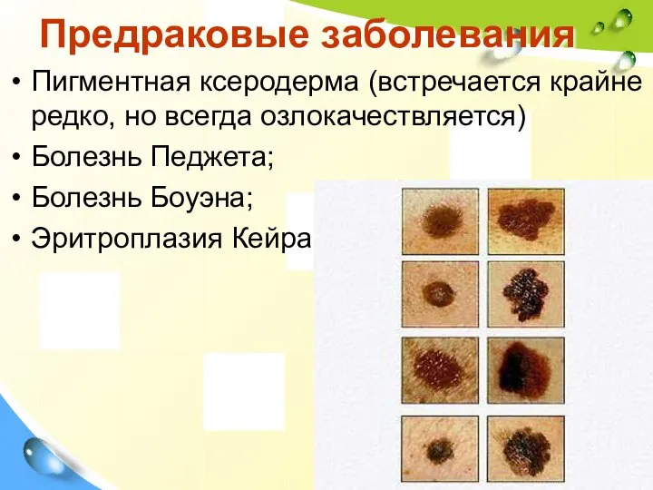 Предраковые заболевания Пигментная ксеродерма (встречается крайне редко, но всегда озлокачествляется) Болезнь Педжета; Болезнь Боуэна; Эритроплазия Кейра