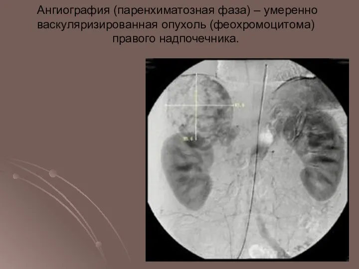 Ангиография (паренхиматозная фаза) – умеренно васкуляризированная опухоль (феохромоцитома) правого надпочечника.