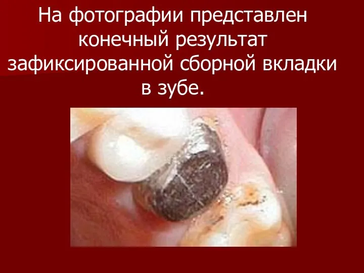 На фотографии представлен конечный результат зафиксированной сборной вкладки в зубе.