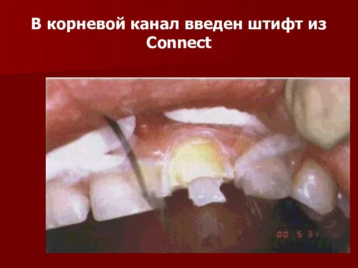 В корневой канал введен штифт из Connect