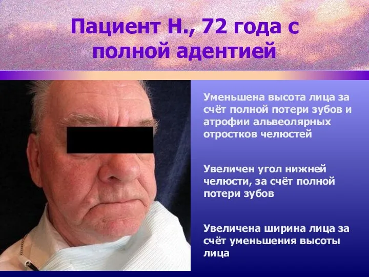 Пациент Н., 72 года с полной адентией Уменьшена высота лица за