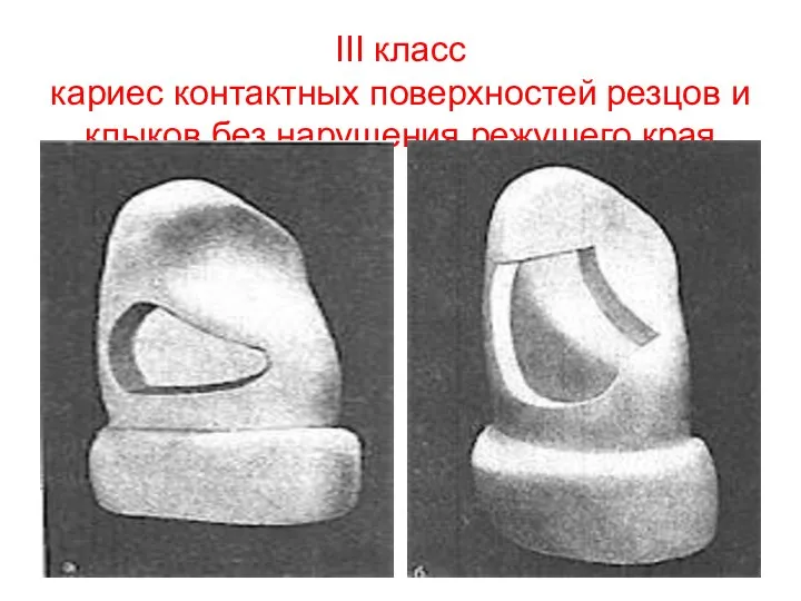 III класс кариес контактных поверхностей резцов и клыков без нарушения режущего края