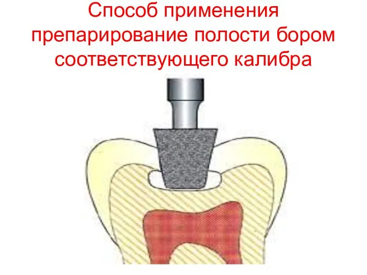 Способ применения препарирование полости бором соответствующего калибра