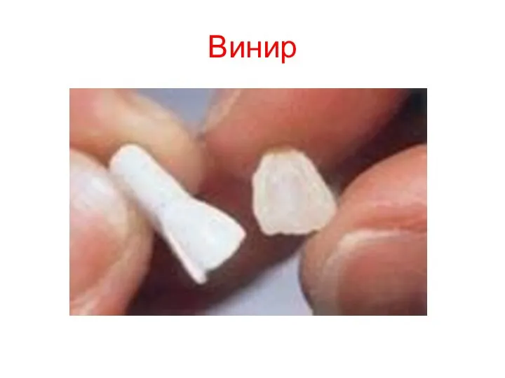 Винир