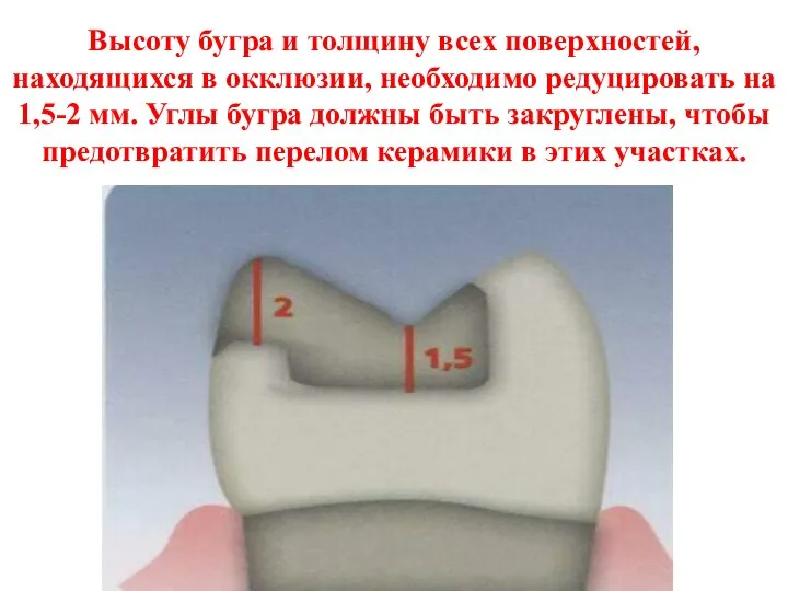 Высоту бугра и толщину всех поверхностей, находящихся в окклюзии, необходимо редуцировать