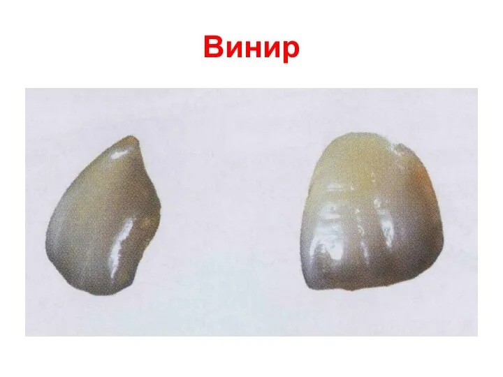 Винир