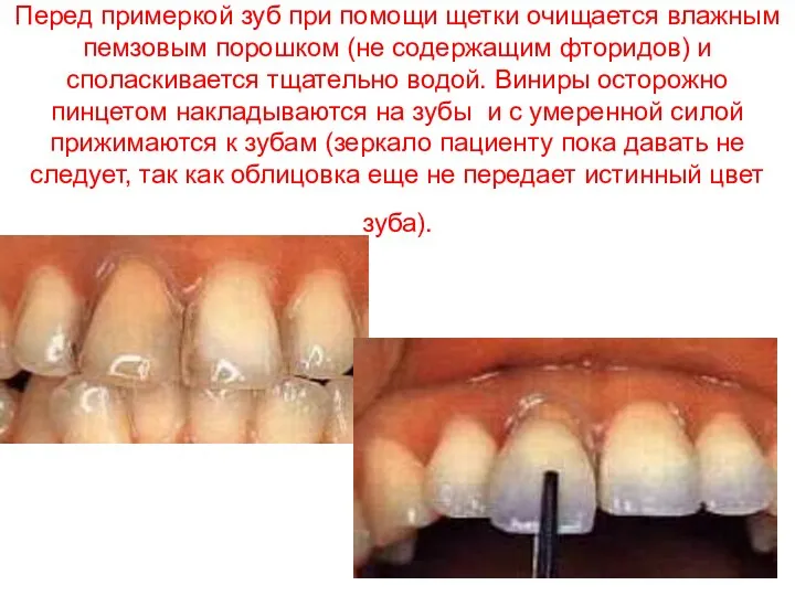 Перед примеркой зуб при помощи щетки очищается влажным пемзовым порошком (не