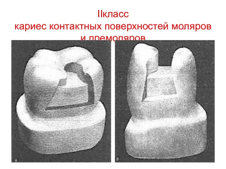 IIкласс кариес контактных поверхностей моляров и премоляров