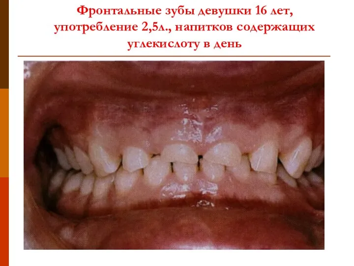 Фронтальные зубы девушки 16 лет, употребление 2,5л., напитков содержащих углекислоту в день