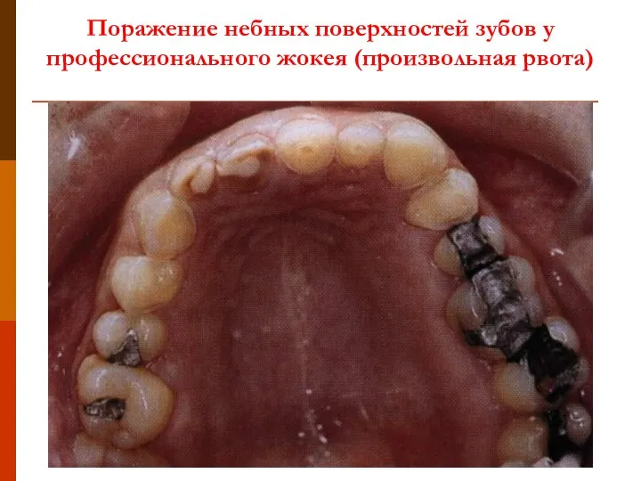 Поражение небных поверхностей зубов у профессионального жокея (произвольная рвота)