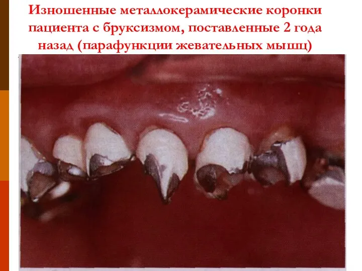 Изношенные металлокерамические коронки пациента с бруксизмом, поставленные 2 года назад (парафункции жевательных мышц)