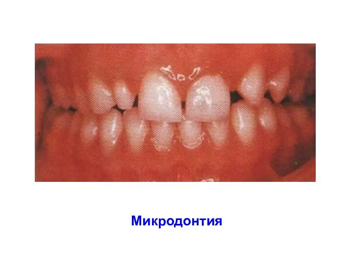 Микродонтия