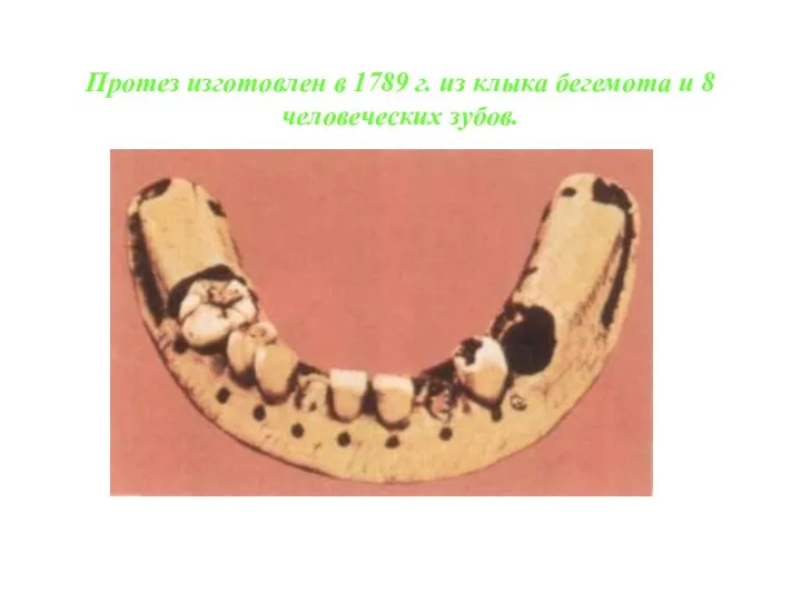 Протез изготовлен в 1789 г. из клыка бегемота и 8 человеческих зубов.