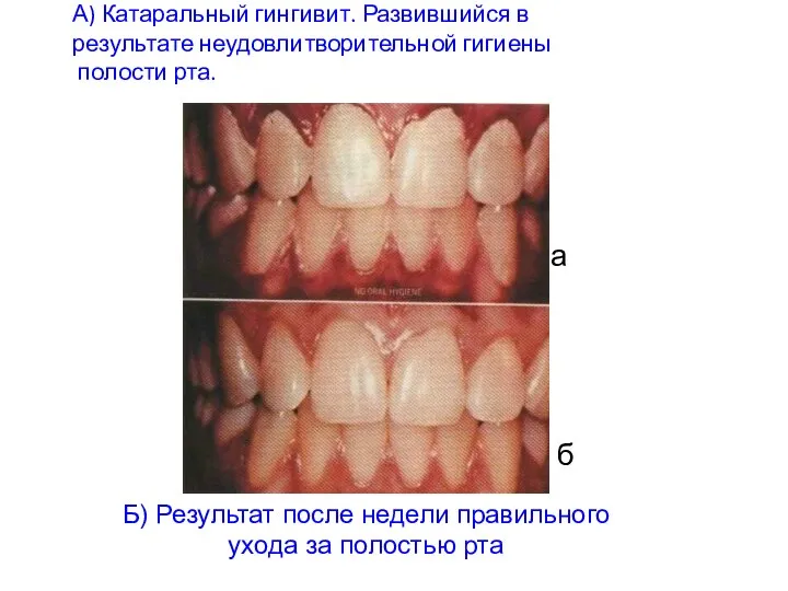 А) Катаральный гингивит. Развившийся в результате неудовлитворительной гигиены полости рта. а