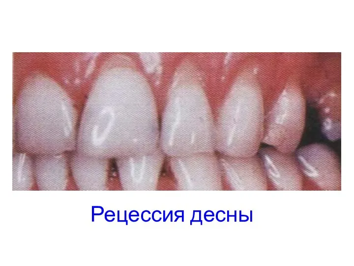 Рецессия десны