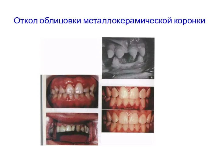 Откол облицовки металлокерамической коронки