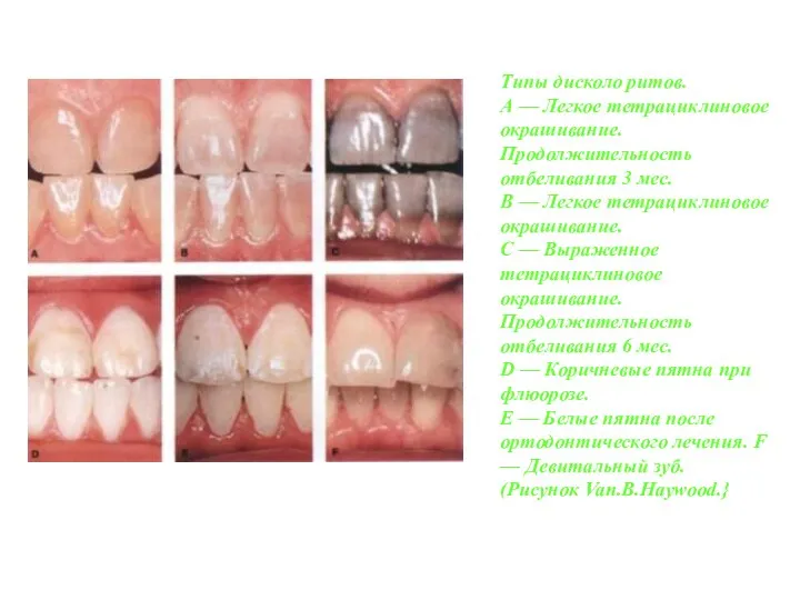 Типы дисколо ритов. А — Легкое тетрациклиновое окрашивание. Продолжительность отбеливания 3