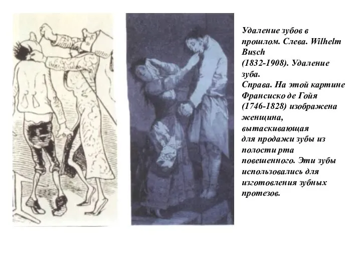 Удаление зубов в прошлом. Слева. Wilhelm Busch (1832-1908). Удаление зуба. Справа.