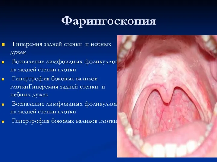 Фарингоскопия Гиперемия задней стенки и небных дужек Воспаление лимфоидных фоликуллов на