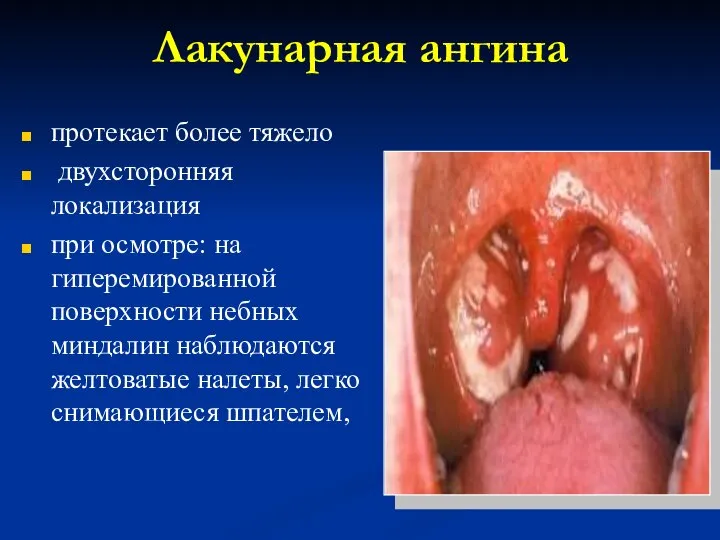 Лакунарная ангина протекает более тяжело двухсторонняя локализация при осмотре: на гиперемированной