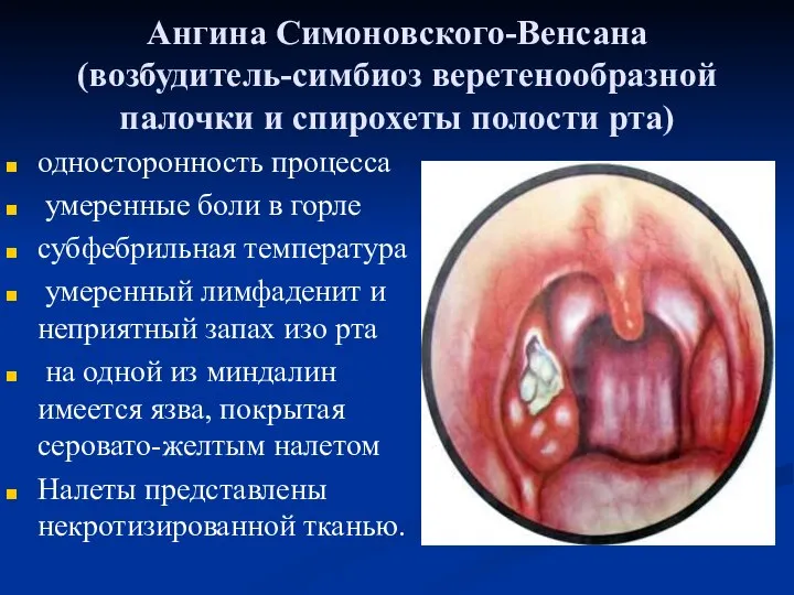 Ангина Симоновского-Венсана (возбудитель-симбиоз веретенообразной палочки и спирохеты полости рта) односторонность процесса