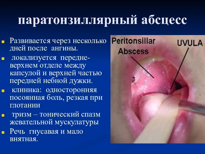 паратонзиллярный абсцесс Развивается через несколько дней после ангины. локализуется передне-верхнем отделе