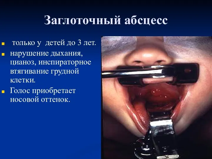 Заглоточный абсцесс только у детей до 3 лет. нарушение дыхания, цианоз,