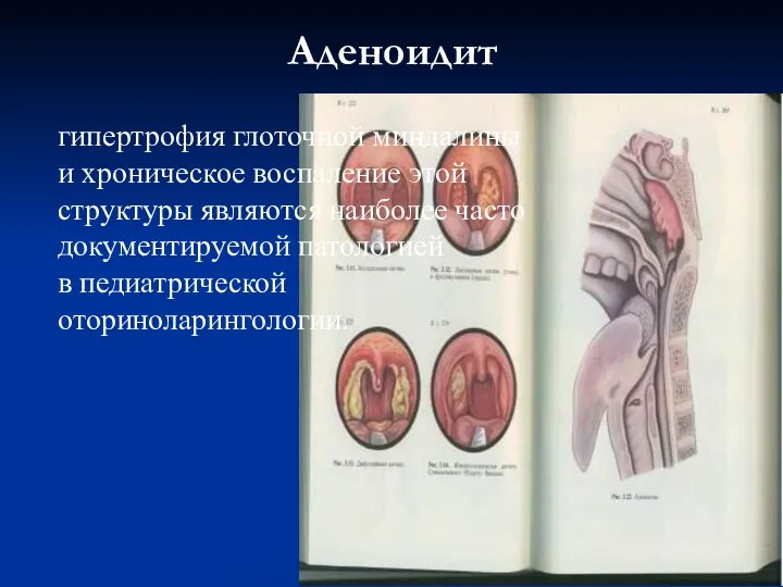 Аденоидит гипертрофия глоточной миндалины и хроническое воспаление этой структуры являются наиболее