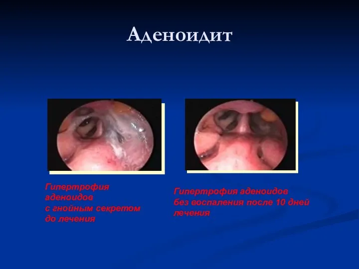 Аденоидит Гипертрофия аденоидов с гнойным секретом до лечения Гипертрофия аденоидов без воспаления после 10 дней лечения